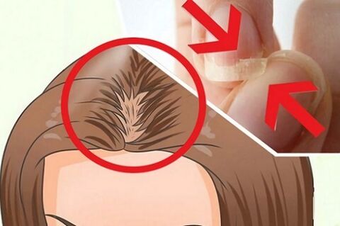 problèmes de cheveux et d'ongles dus à des parasites